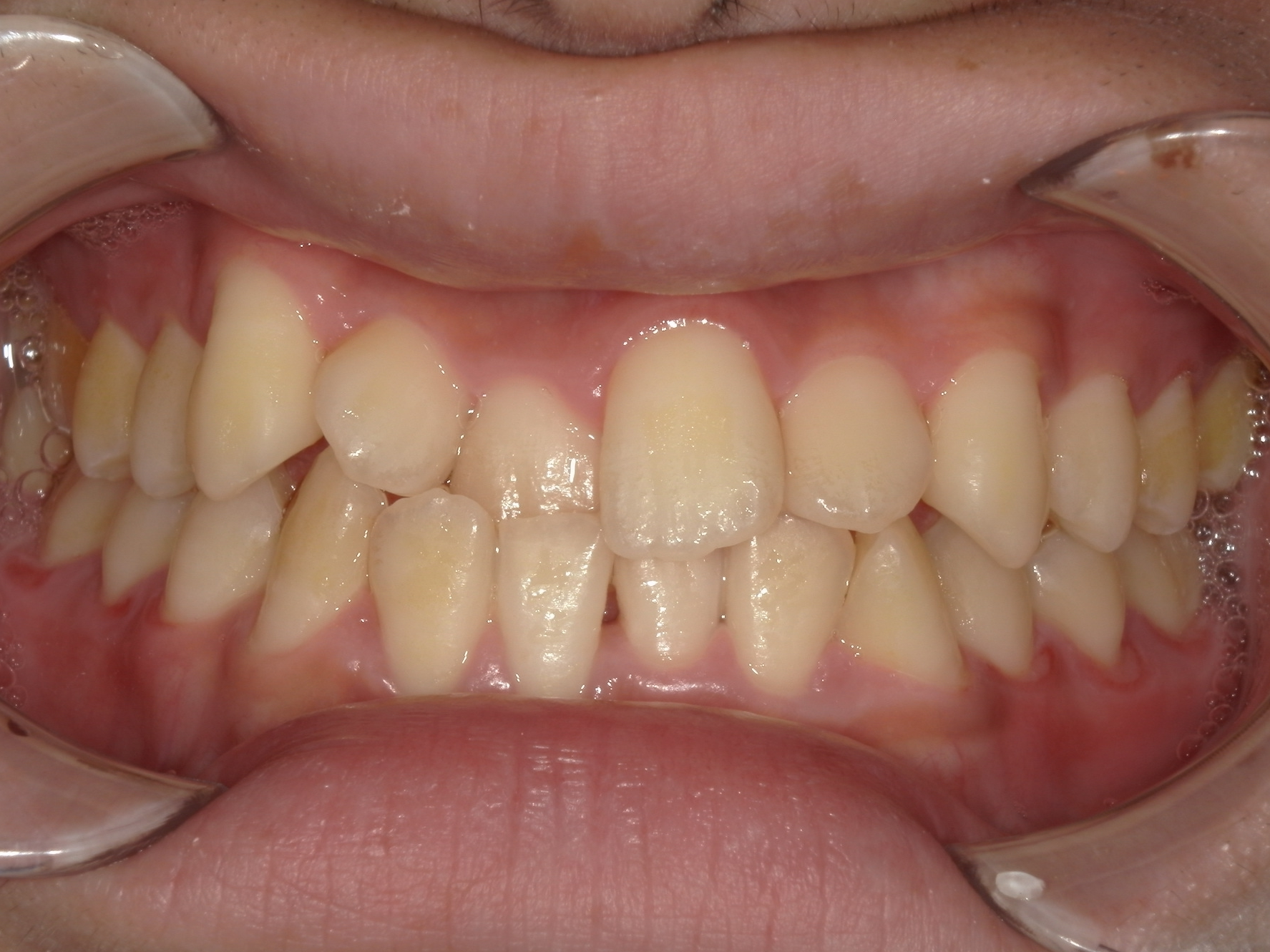before